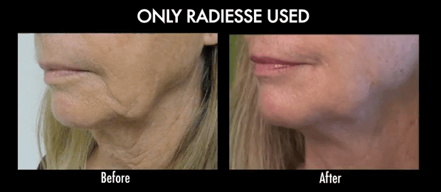 No Surgery Face Lift: How to get a more defined face without surgery. No Surgery Face Lift also known as Liquid facelift before and after: How to get a more defined lower face without surgery.