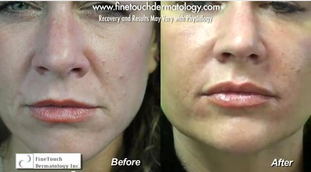 Face lift without surgery results. Face lift without surgery results.
