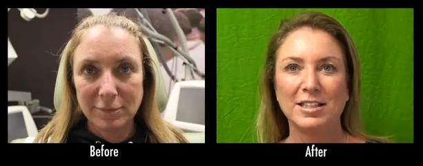 This patient used facial sculpting injections for her non invasive facial contouring. This patient used facial sculpting injections for her non invasive facial contouring.
