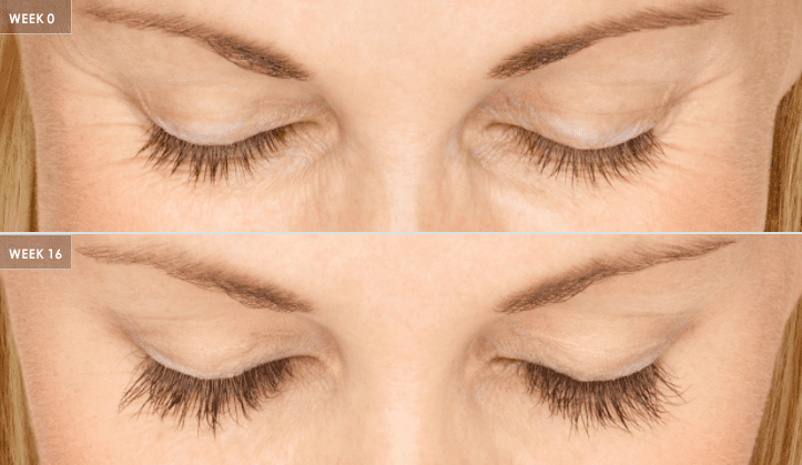 Latisse eyelash treatment comparison photos. 