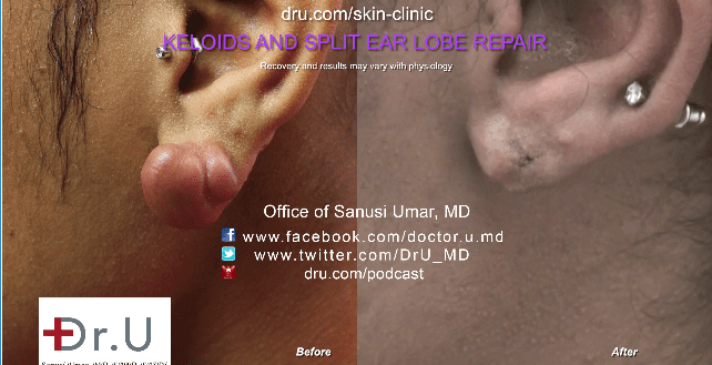 Successful split ear repair surgery in Los Angeles Successful split ear repair surgery in Los Angeles