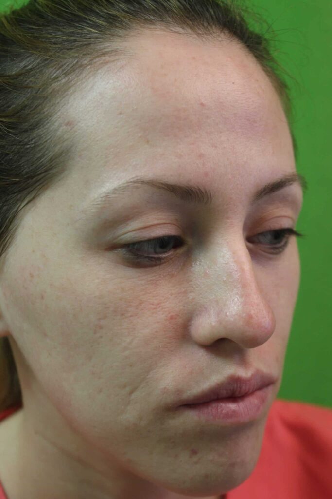 A young patient of Dr U in Manhattan Beach Los Angeles who presented with complaint of laugh line wrinkles A young patient of Dr U in Manhattan Beach Los Angeles who presented with complaint of laugh line wrinkles