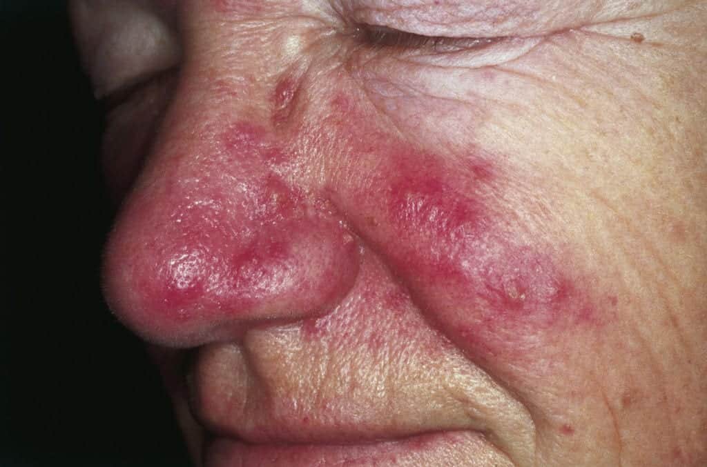 Rosacea is a common skin condition that appears in the form of redness and bumps on the skin. Continue reading this article for more rosacea information and red face treatment options with Dr. U.