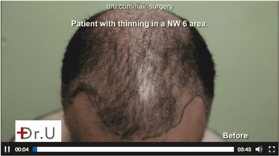 Before Dr. Umar completed his chest hair to head transplant for Canadian Before Dr. Umar completed his chest hair to head transplant for Canadian