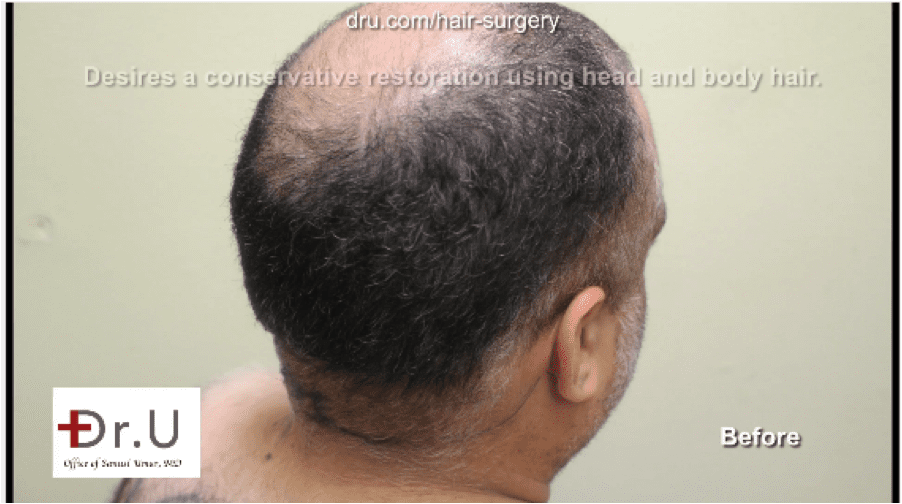 Body Hair transplant for canadians are available in LA by Dr. Umar. Body Hair transplant for canadians are available in LA by Dr. Umar.