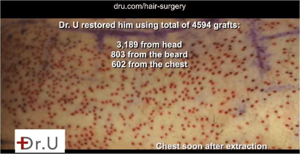 The patient used 602 grafts from his chest hair to head transplant. The patient used 602 grafts from his chest hair to head transplant.