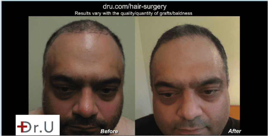 This patient is very pleased with his Natural hair transplant results using DrUGraft.* This patient is very pleased with his Natural hair transplant results using DrUGraft.*