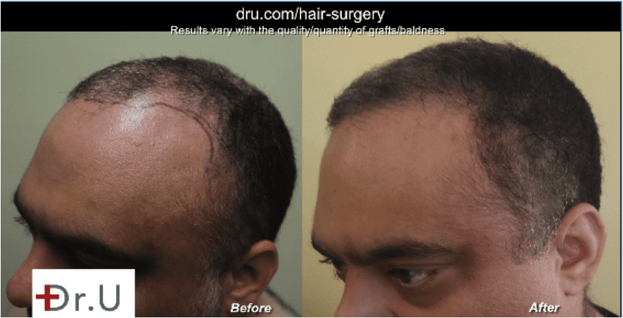 Are you interested in a body hair transplant for canadians? Dr. U in Manhattan Beach is here to help.* Are you interested in a body hair transplant for canadians? Dr. U in Manhattan Beach is here to help.*