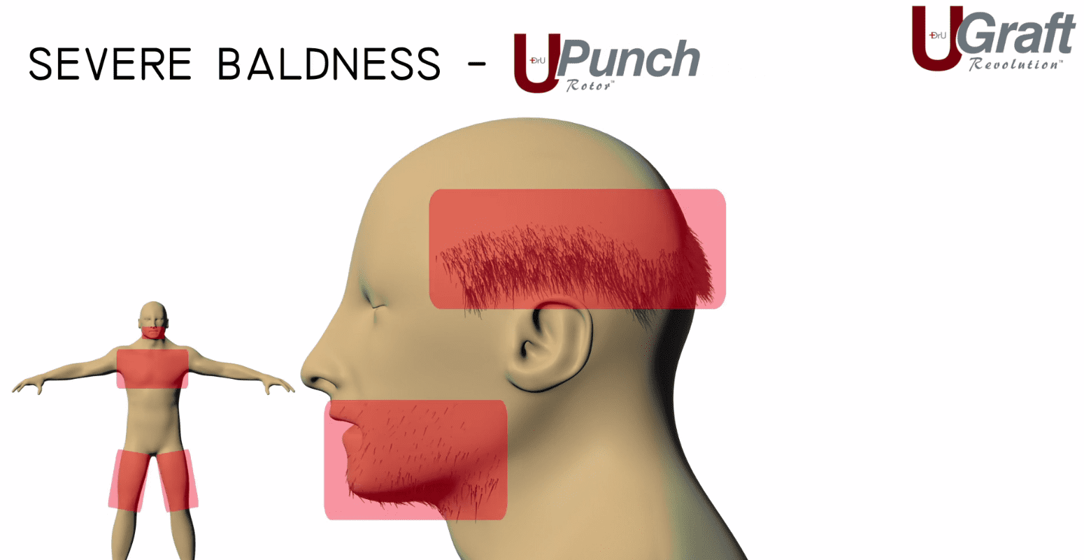 Using grafts from the beard and body expand the donor selection for severely bald patients like this one.