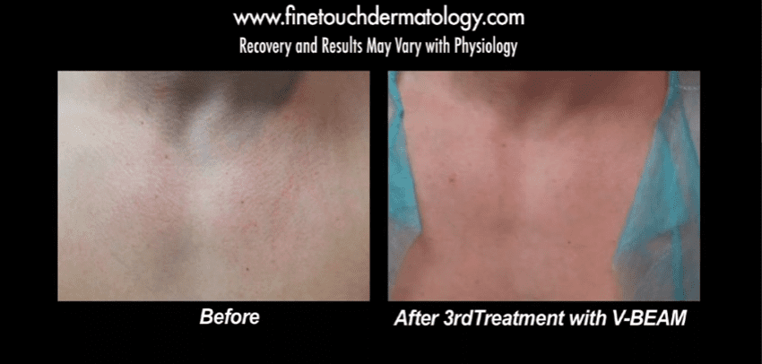 Three sessions with V Beam laser, also called a V laser treatment, cleared this patients rosacea.*