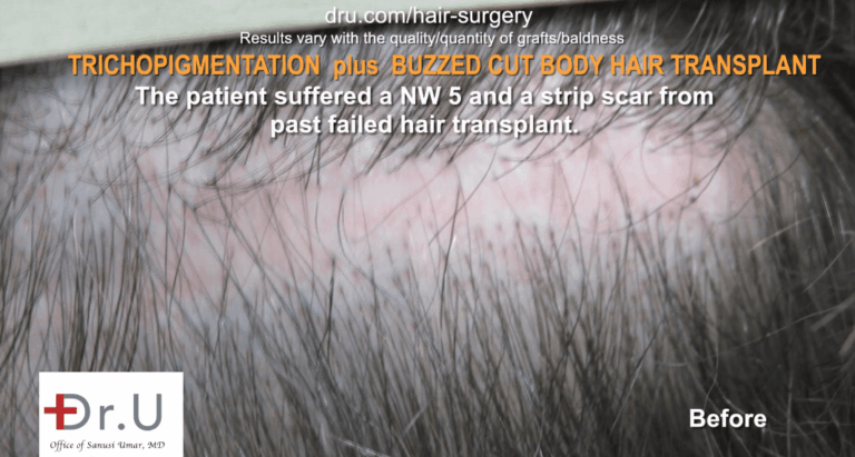 The patient before Dr.UGraft FUE Plus SMP. The patient before Dr.UGraft FUE Plus SMP.