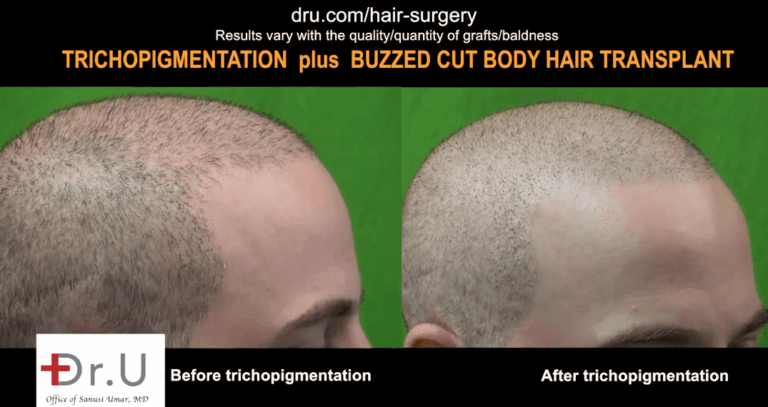 Incredible results of SMP after FUE hair transplant. Incredible results of SMP after FUE hair transplant.