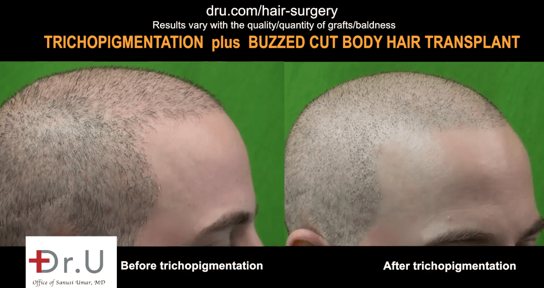 Trichopigmentation was used to create the appearance of greater density for this patient. Here are before and after photos where the look of an even greater hair transplant density was achieved Trichopigmentation was used to create the appearance of greater density for this patient. Here are before and after photos where the look of an even greater hair transplant density was achieved