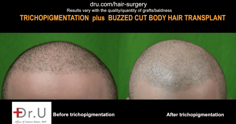 Dr.UGraft FUE Plus SMP Before and After SMP affect hair transplant success