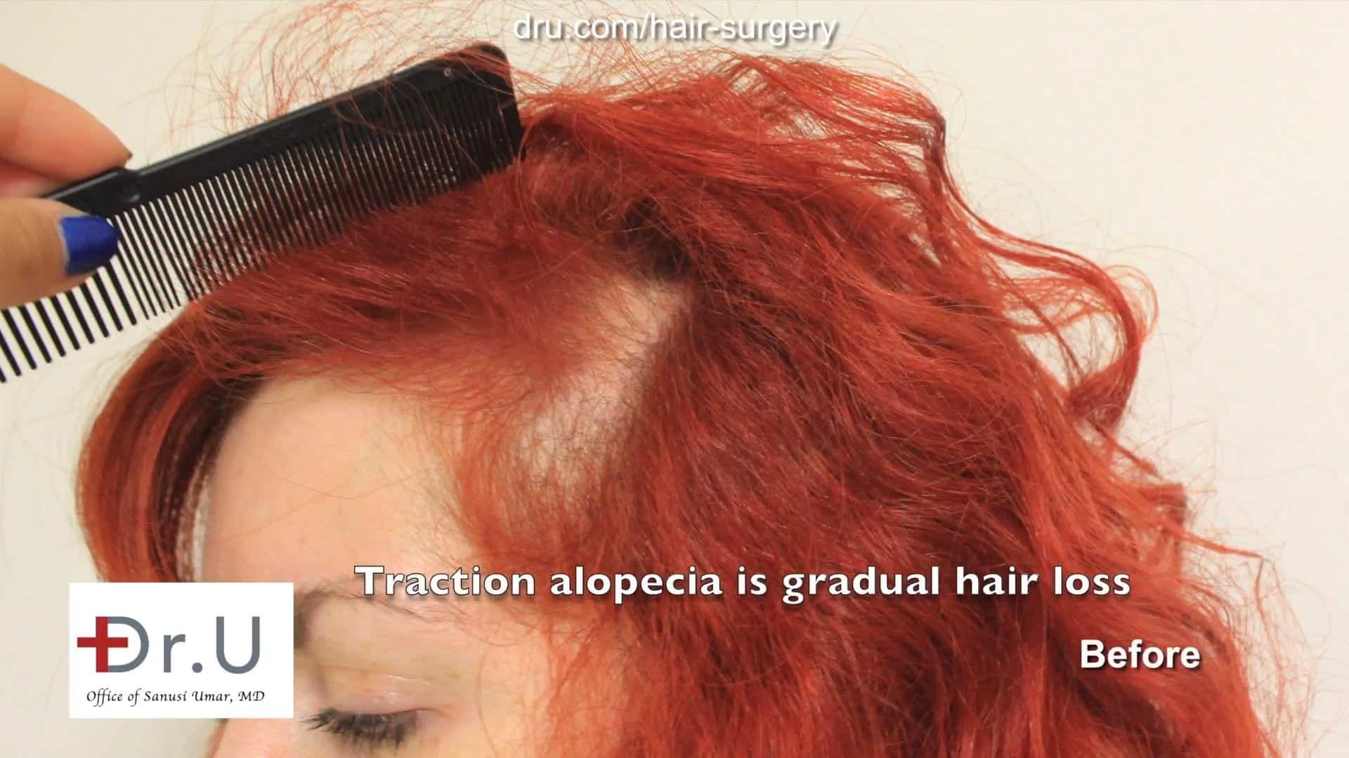 Before hair transplant for female traction alopecia using Dr UGraft