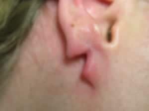 When an earlobe splits it will start to heal the two separate halves. This can create very noticeable damage, such is the case for this patient. When an earlobe splits it will start to heal the two separate halves. This can create very noticeable damage, such is the case for this patient.