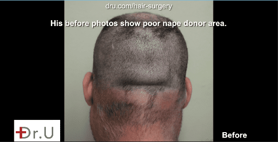 After a shave test this patient proved to have a poor nape donor area. After a shave test this patient proved to have a poor nape donor area.