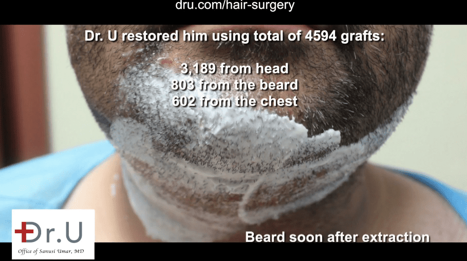 The patients beard donor area shortly after his extraction. The patients beard donor area shortly after his extraction.