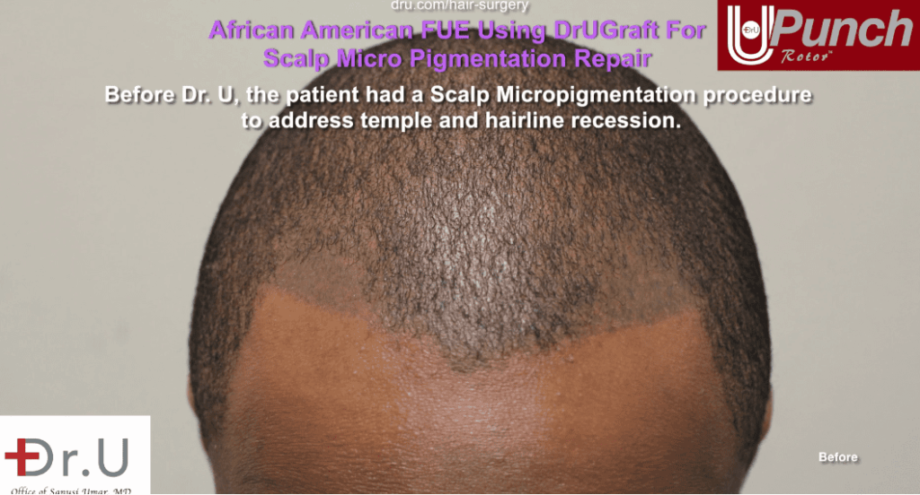 An example of bad African american scalp tattoos, before Dr.UPunch.