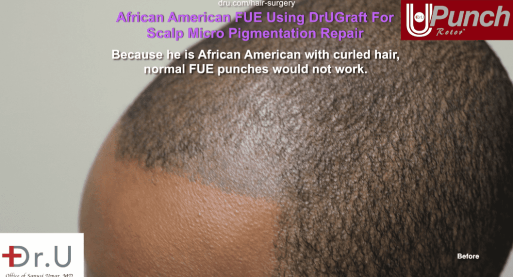 A botched tattooed hairline before Dr.UPunch.