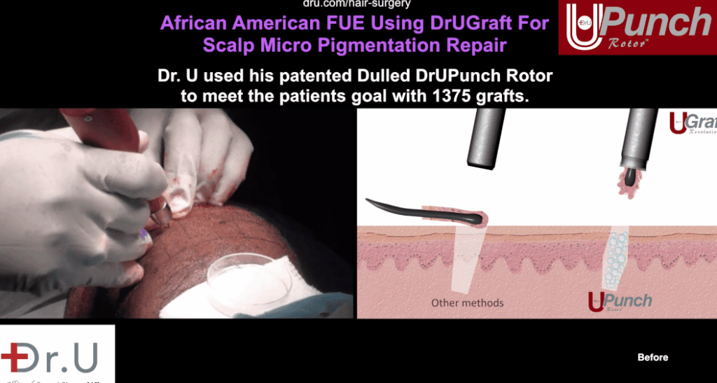 Dr U used his patented, dulled Dr.UPunch motor for SMP repair.