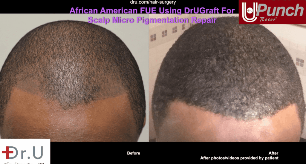 The patient's bad hair tattoo before and after repair.