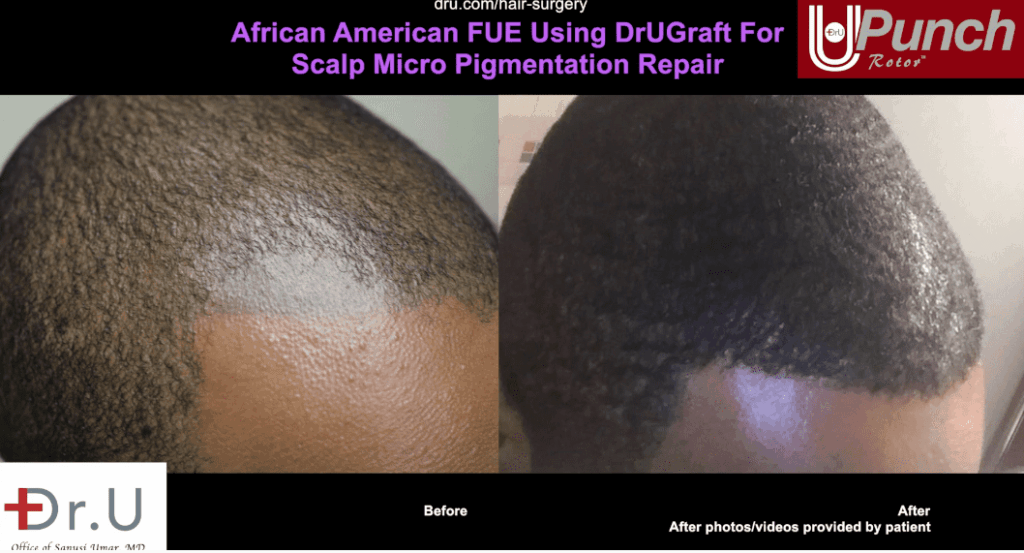 The results of bad hair tattoo repair by Dr.UPunch.