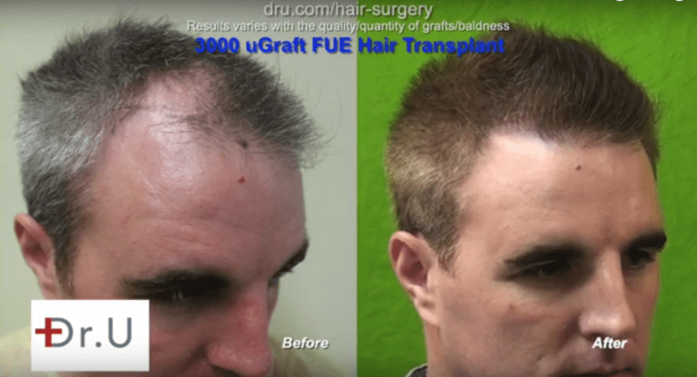 Hair Transplant Consultation Process - viewing past patient results