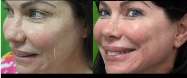 Belotero Fine smile lines or smile wrinkle treatment before and after in a Manhattan Beach Los Angeles patient of Dr U Belotero Fine smile lines or smile wrinkle treatment before and after in a Manhattan Beach Los Angeles patient of Dr U