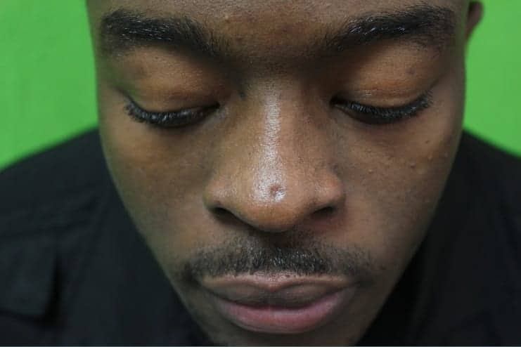 Can you get a scar removed? Scar removal possible with laser technology.