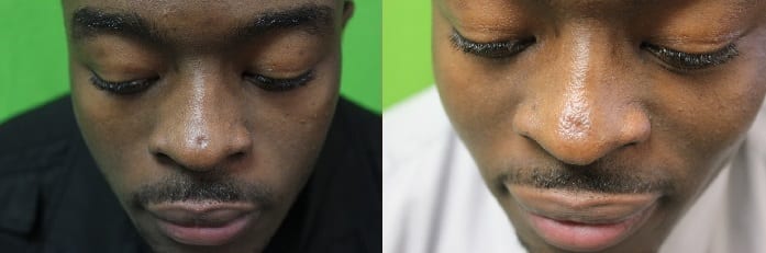 Surgical scar removal before and after powerfully boosts confidence In this Manhattan beach Los Angeles patient of Dr U