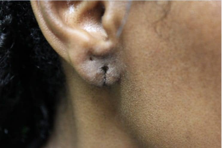 This patient came to Dr. Umar with a completely ripped earlobe. This patient came to Dr. Umar with a completely ripped earlobe.