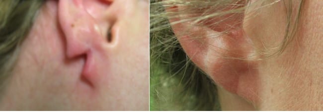 This split earlobe repair by Dr. Umar was a huge transformation. This patient no longer brings unwanted attention to her ears.* This split earlobe repair by Dr. Umar was a huge transformation. This patient no longer brings unwanted attention to her ears.*