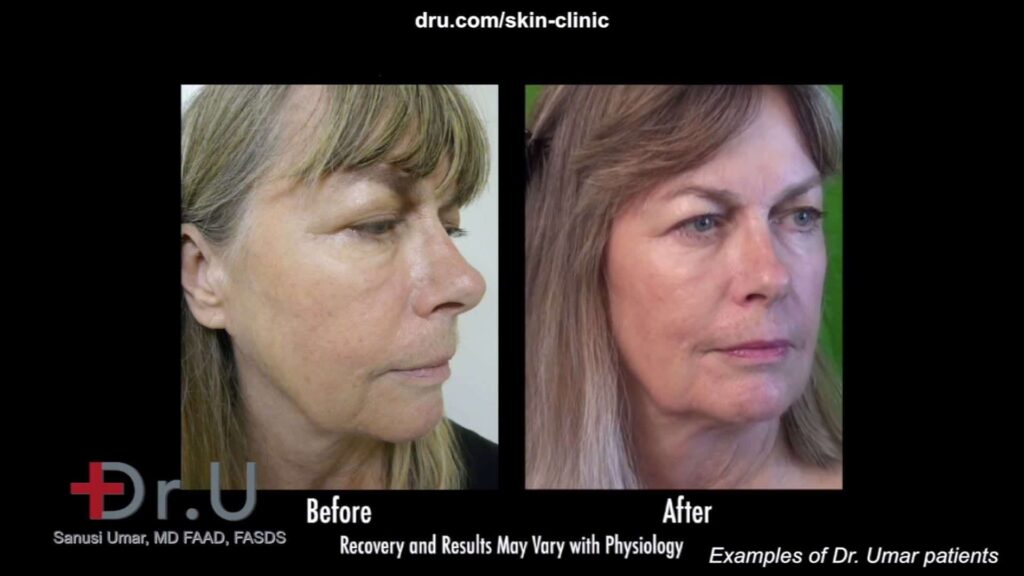 Non surgical liquid facelift using Radiesse by Dr U prevents the need for a lower facelift