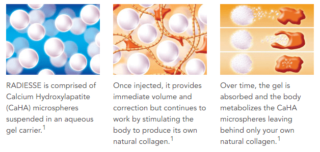 Radiesse provides immediate correction and continues to work by allowing the body to produce its own natural collagen. Radiesse provides immediate correction and continues to work by allowing the body to produce its own natural collagen.