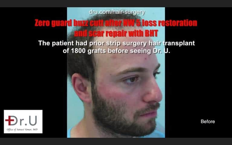 Fix strip surgery hair transplant: Hair coverage before Dr.UGraft to Repair Strip Surgery, Scarring and Baldness