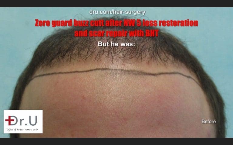 Dr.UGraft to Repair Strip Surgery, Scarring and Baldness: Hair Density Before treatment