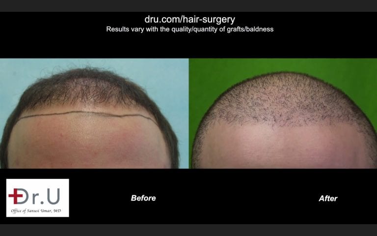 The Dr.UGraft Method: Repair Strip Surgery Before and After 