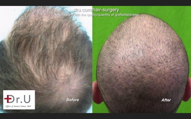 Hair graft quality is illustrated by the hair transplant growth yield experienced by patients * Hair graft quality is illustrated by the hair transplant growth yield experienced by patients *
