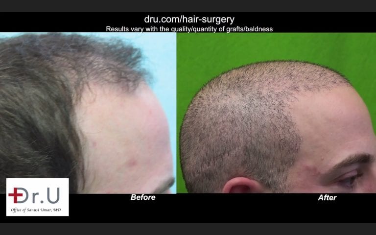 Fix bad hair transplant: Great results to Repair Strip Surgery, Scarring and Baldness 