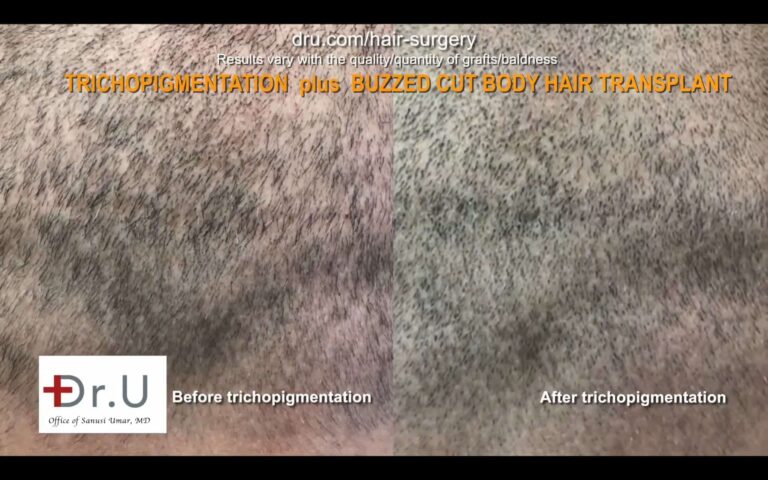 Hair transplant scar cover up by DrUGraft BHT & SMP. Hair transplant scar cover up by DrUGraft BHT & SMP.