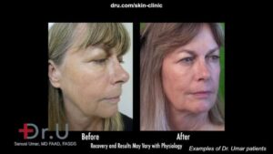 Radiesse can be used to reduce the appearance of jowls.
