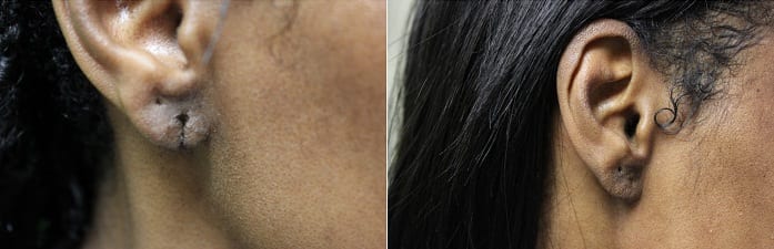Thanks to Dr. Umar, this patient now has a regular looking earlobe with minimal scarring. She is now also able to re-pierce her ears (in a separate spot) if she wishes.* Thanks to Dr. Umar, this patient now has a regular looking earlobe with minimal scarring. She is now also able to re-pierce her ears (in a separate spot) if she wishes.*