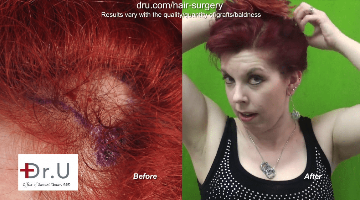 Patient is happy with her traction alopecia treatment results at the Dr. U Hair and Skin Clinic.*