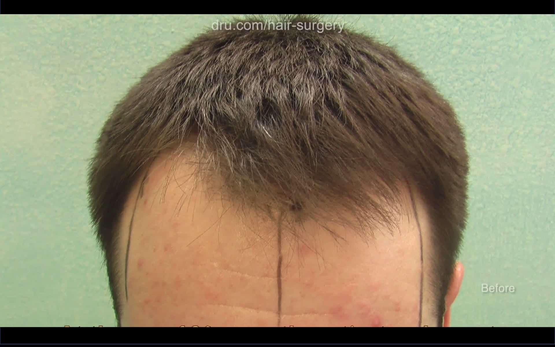 If done at too young an age, a patient can still experience hair loss after hair transplant: Patient's hair loss before treatment 