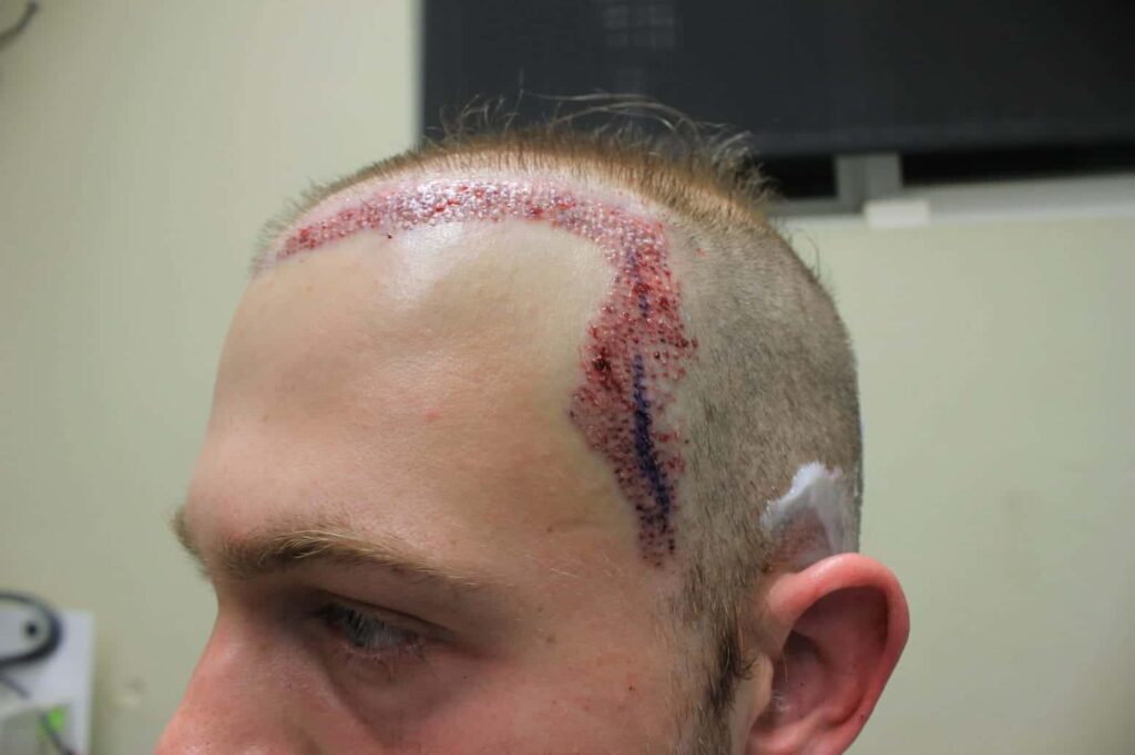 The second part of the hair transplant process during surgery involves insertion of the donor grafts into the recipient area 