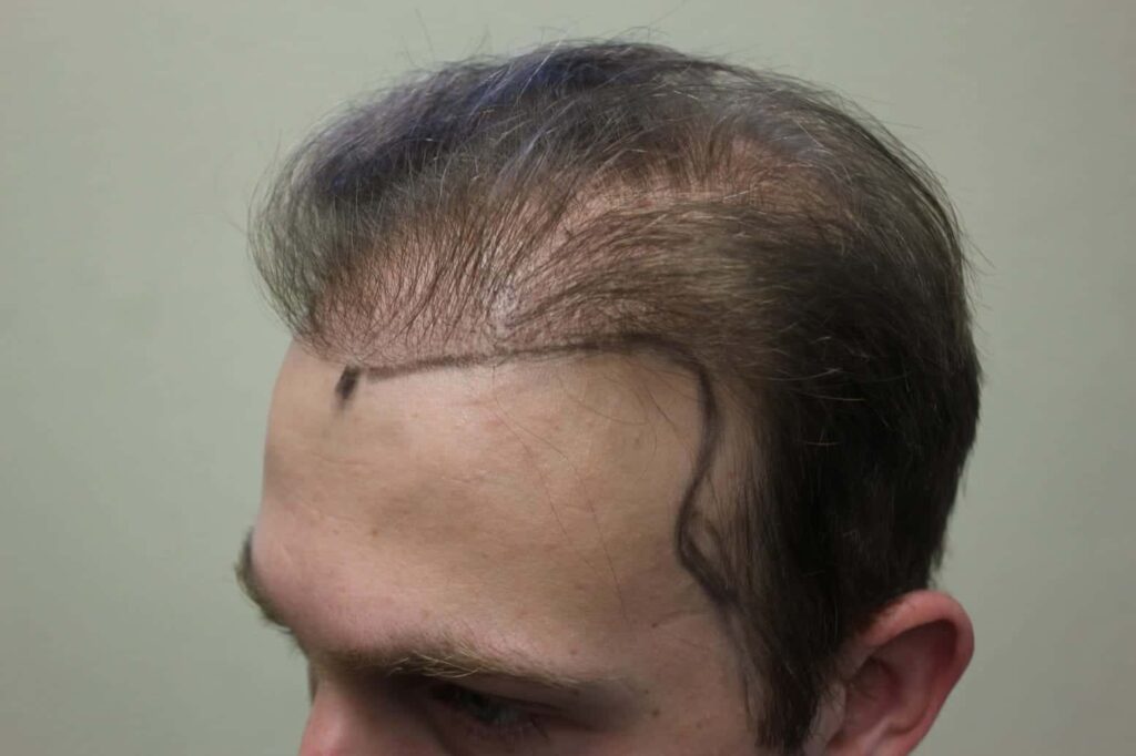 Taking photos of your original hair loss condition is the first part of the procedure for hair transplant surgery