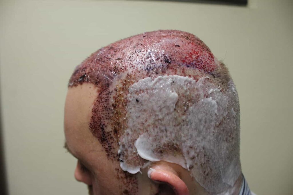 Hair Transplant Process - Donor and Recipient Area Healing