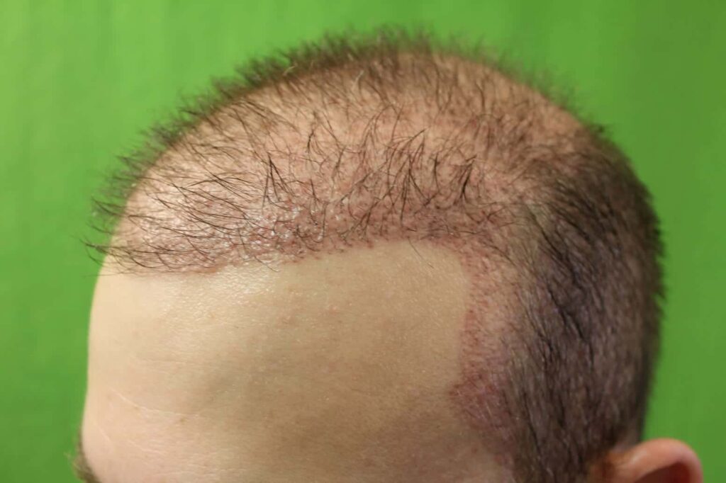 Patient showing new signs of hair growth just one month following his procedure for hair transplant surgery.