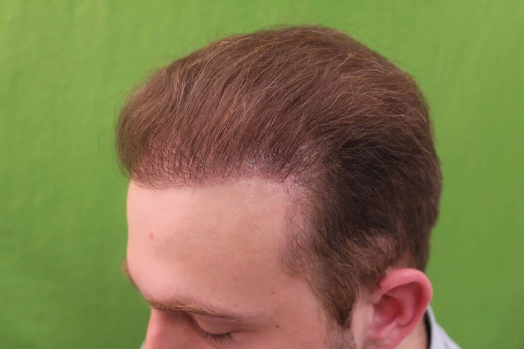 Hair Transplant Process - 13 month follow up